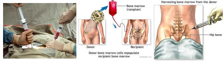 transplante de medula óssea